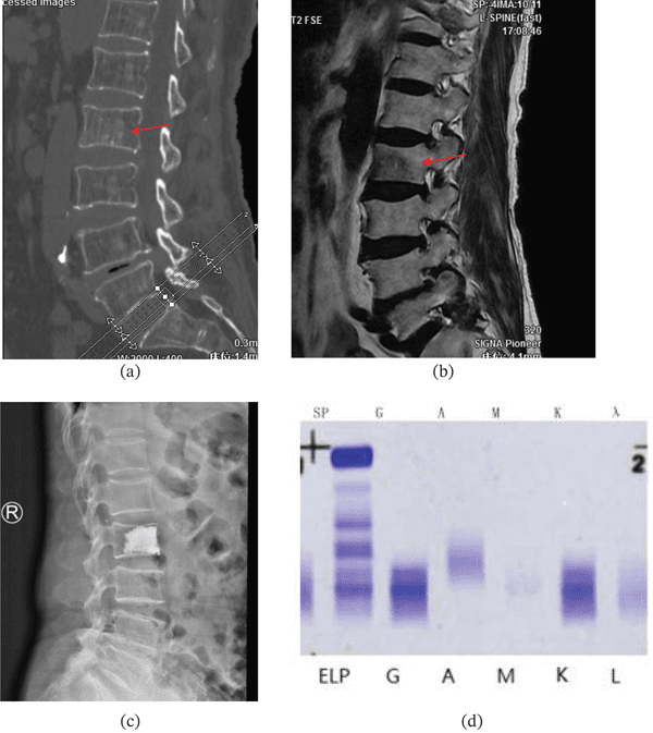 Sagittal spine CT and MRI, lateral radiograph with vertebral cement, and an immunofixation gel in myeloma mimicking an osteoporotic vertebral fracture