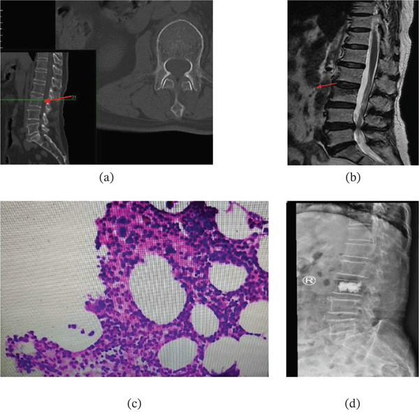 Spine CT, MRI, histology and a radiograph with vertebral cement in pyogenic spondylitis mimicking an osteoporotic fracture
