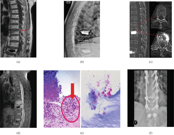 Spine MRI, radiographs, CT, histology and an instrumented radiograph in tuberculous spondylitis mimicking an osteoporotic fracture