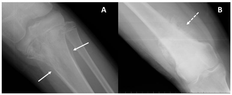 Radiographs showing aggressive periosteal reactions in osteosarcoma