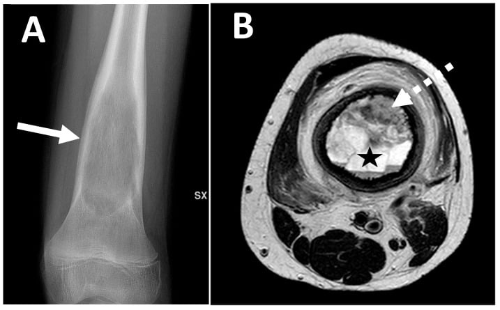 MRI of telangiectatic osteosarcoma showing fluid-fluid levels