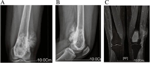 Classic distal femur osteosarcoma with X-ray and MRI