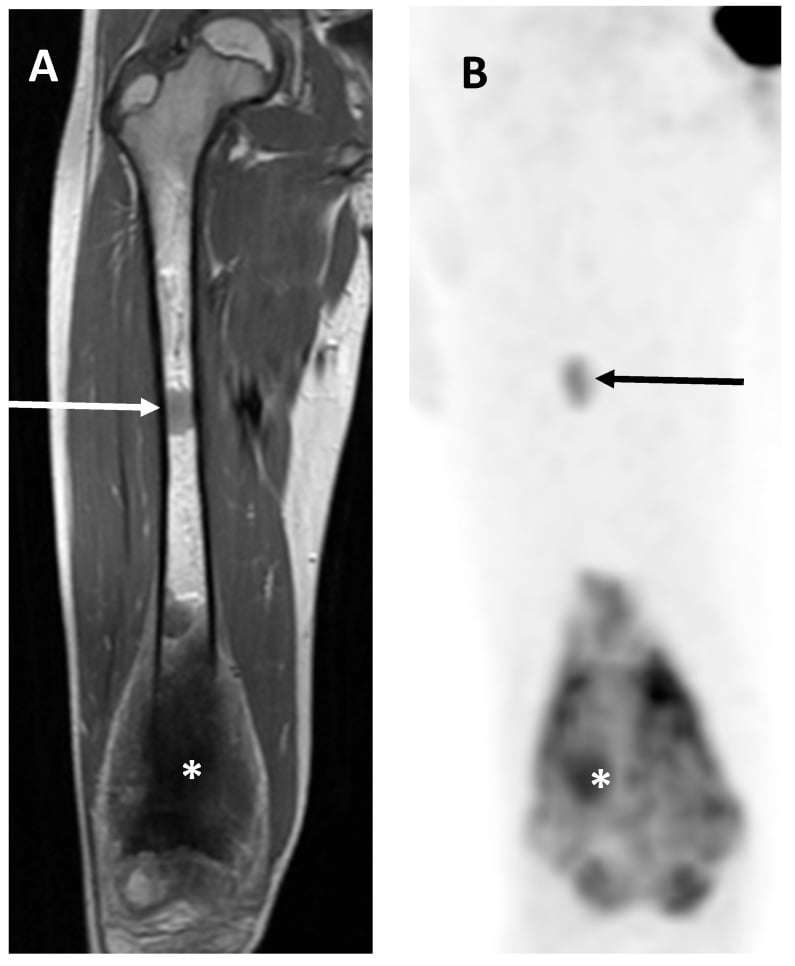 MRI showing skip metastasis in osteosarcoma