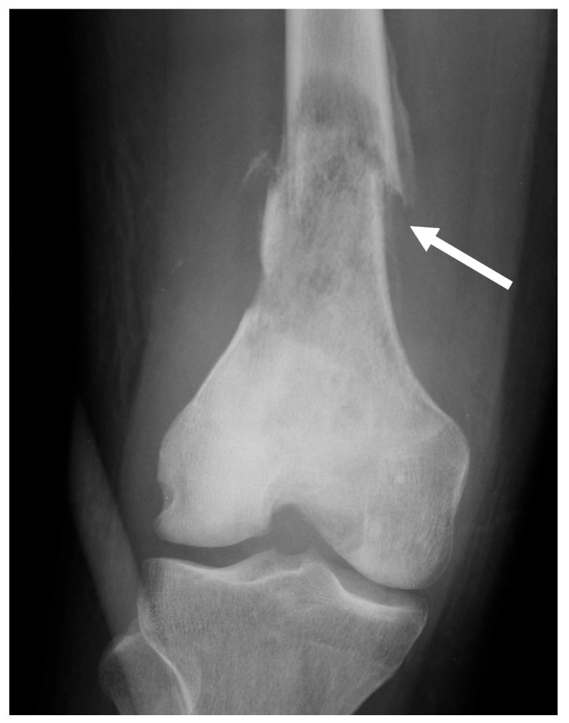 AP X-ray showing pathological fracture through distal femur osteosarcoma