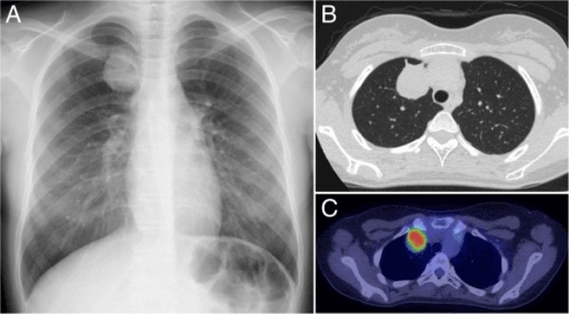 Chest X-ray and CT showing pulmonary metastasis of osteosarcoma