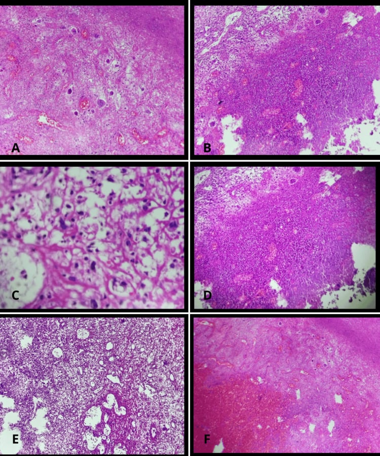 Histology of conventional osteosarcoma with malignant osteoid production