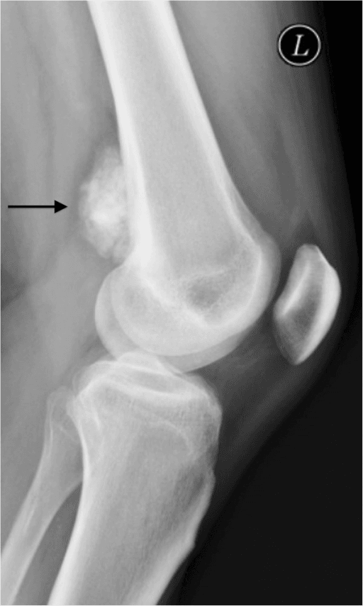 Lateral radiograph of parosteal osteosarcoma at the posterior distal femur