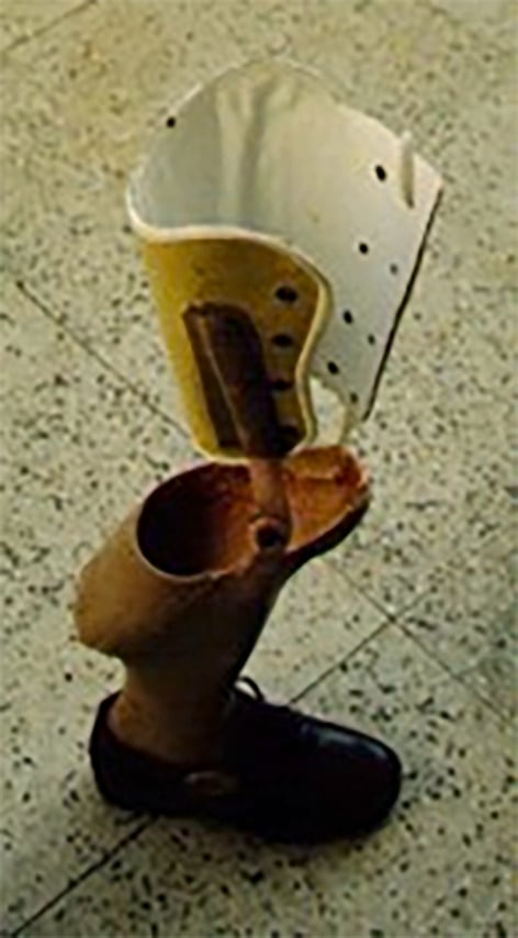 Photograph of a rotationplasty exoprosthesis
