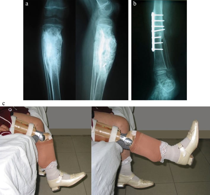 Radiographs and clinical photographs after rotationplasty for proximal tibial osteosarcoma
