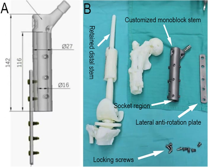 CAD design and printed custom monoblock stem for limb salvage