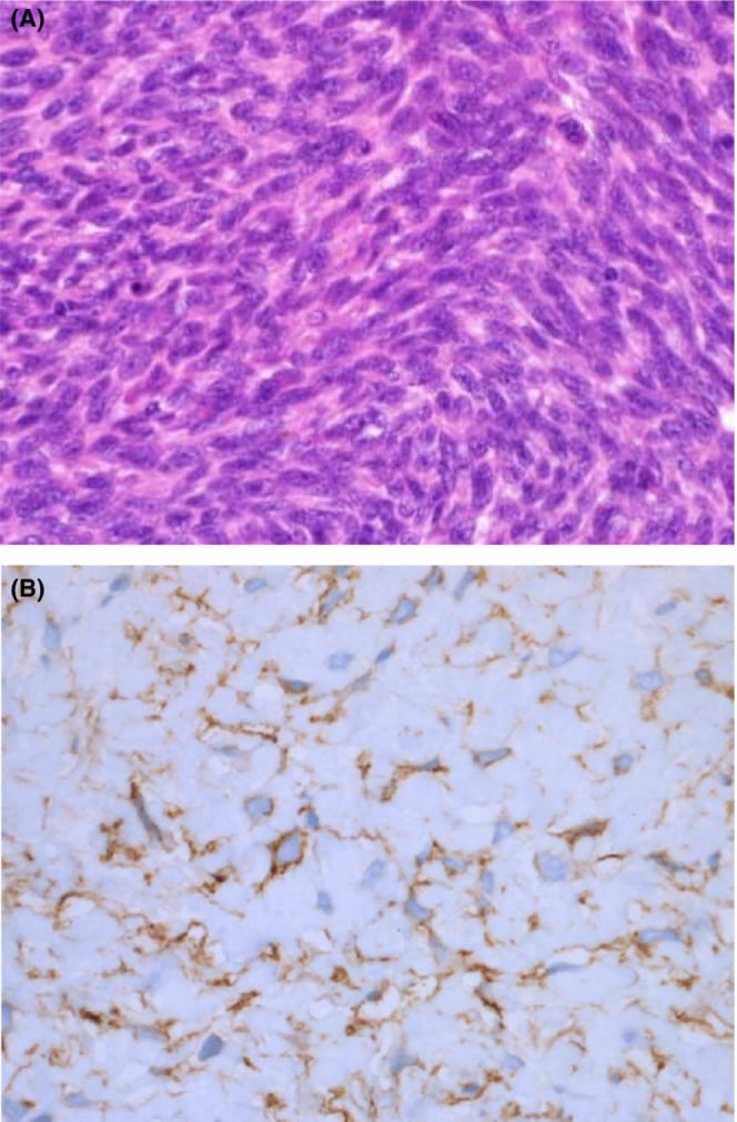 Histology of radiation-induced osteosarcoma with CD34 staining