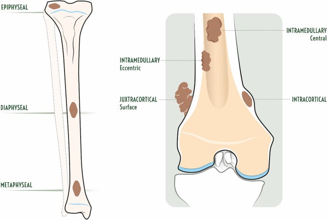 Illustration of longitudinal and transverse tumour locations in long bone
