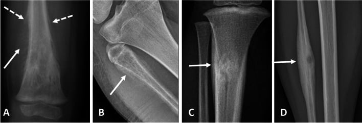 Radiographs showing Codman triangle and sunburst periosteal reaction