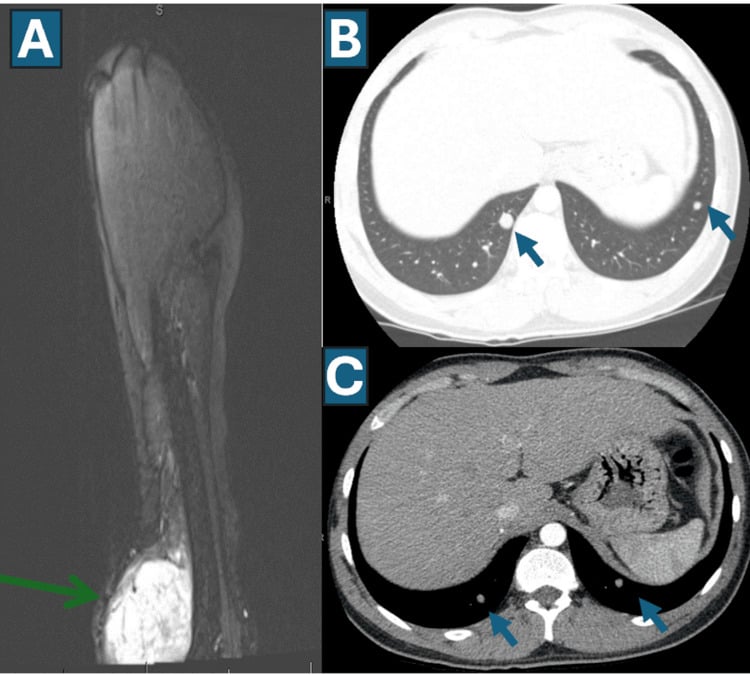 Sequential MRI and CT from diagnosis to first lung metastases