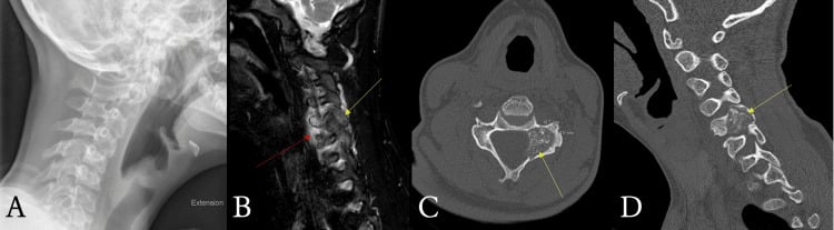 Lateral radiograph and CT slices of spinal osteoblastoma in a child presenting with back pain