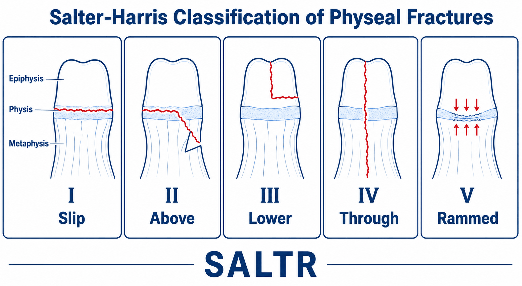 Diagram of the Salter-Harris classification of physeal fractures, types I to V, with the SALTR mnemonic.