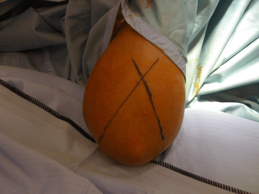 Paediatric elbow comparison views showing ossification centre assessment