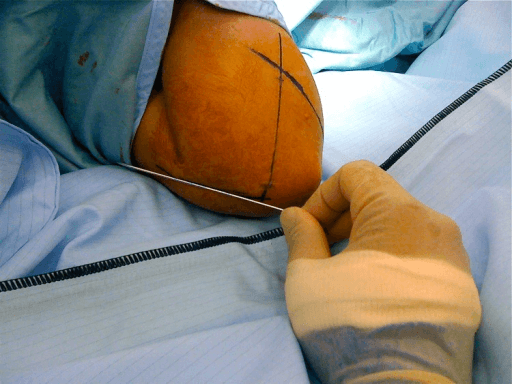 Paediatric fracture patterns unique to the growing skeleton
