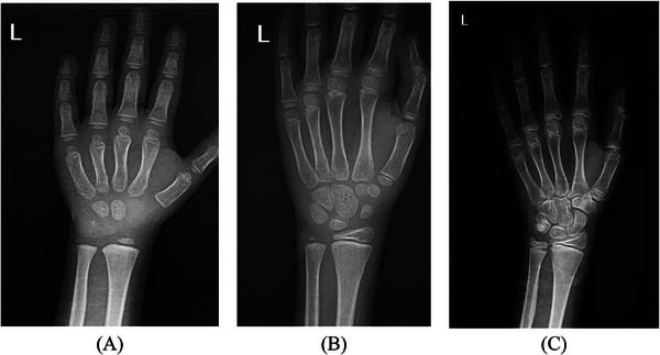 Left-wrist radiographs at ages four, eight and twelve years showing skeletal maturation