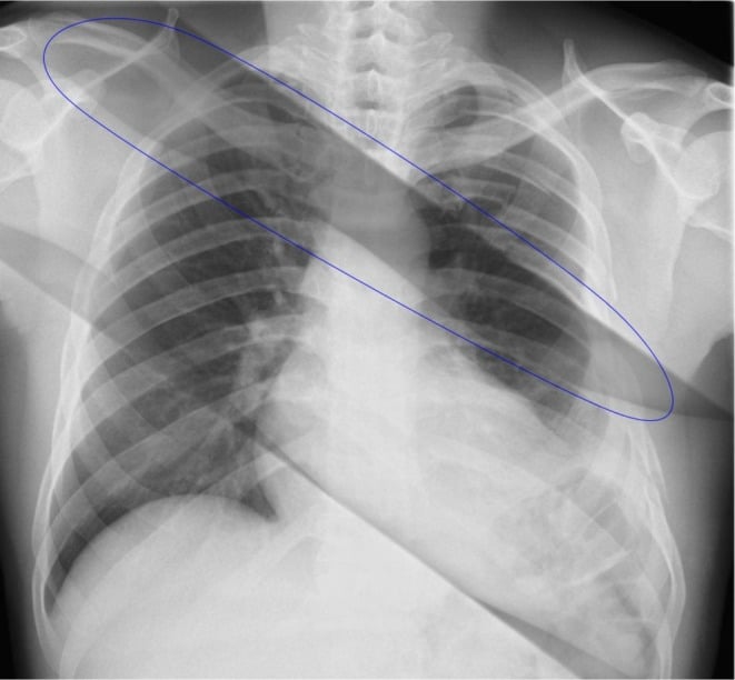 Chest radiograph with diagonal image-plate ghosting artefacts circled in blue