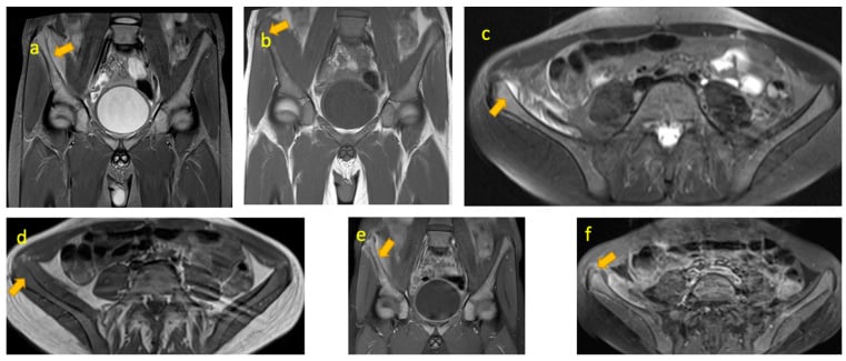 Multisequence MRI of right iliac-crest apophyseal osteomyelitis with subperiosteal abscess