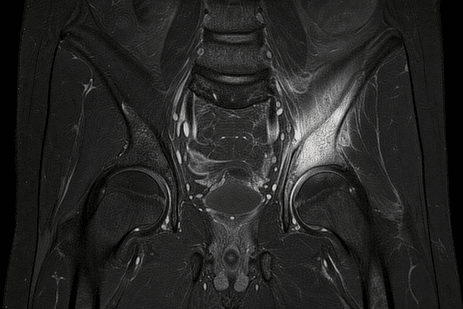 Coronal MRI of the pelvis showing high-signal marrow oedema in the iliac bone near the sacroiliac joint