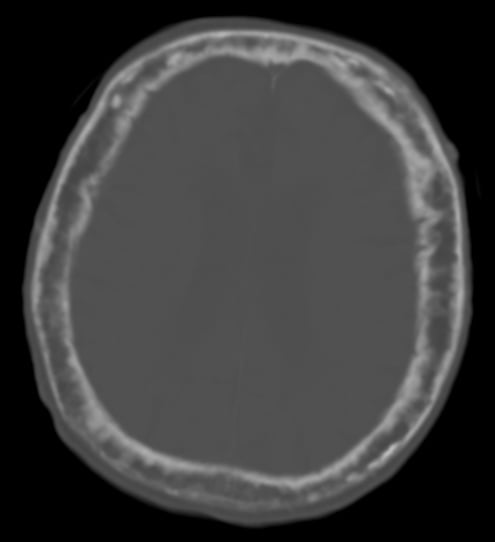 Axial CT of the skull showing diffuse calvarial thickening in Paget's disease