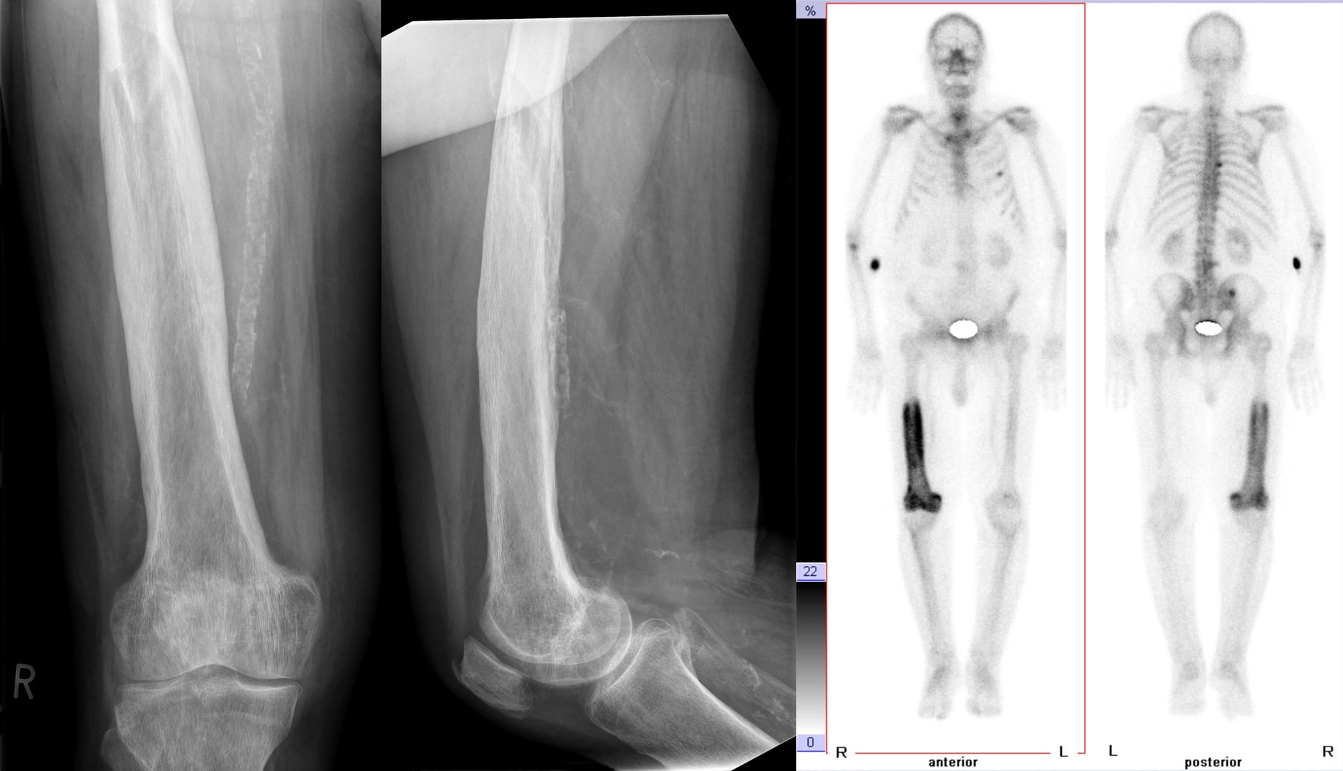 Radiographs and whole-body bone scan of Paget disease of the femur: cortical thickening and coarse trabeculae on X-ray with intense tracer uptake on scintigraphy.