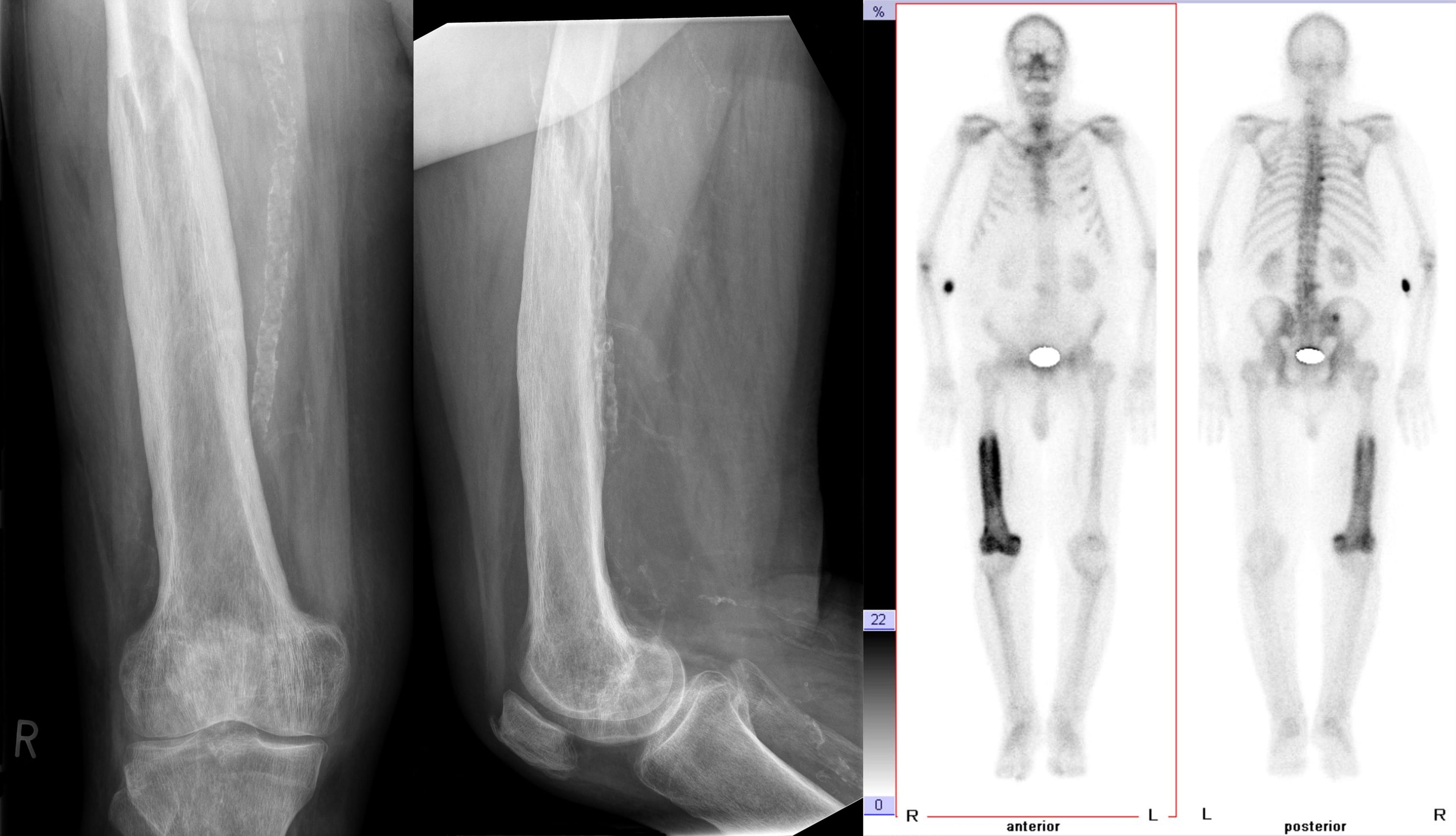 Radiographs and whole-body bone scan of Paget disease of the femur: cortical thickening and coarse trabeculae on X-ray with intense tracer uptake on scintigraphy.