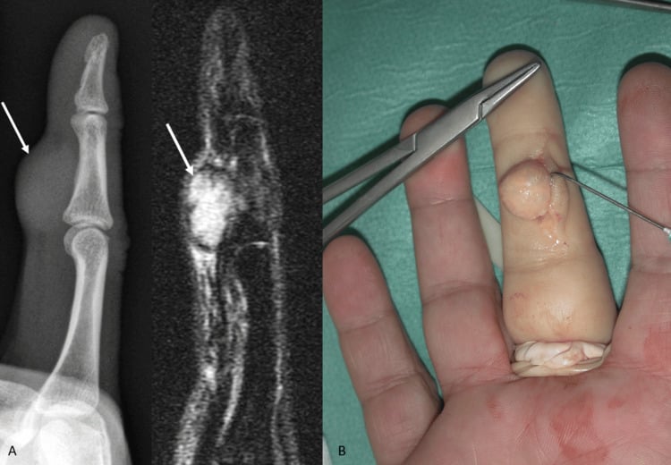 Three-panel figure: radiograph of a finger with palmar scalloping, MRI of a volar sheath mass, and a draped intraoperative view of the excised lesion.