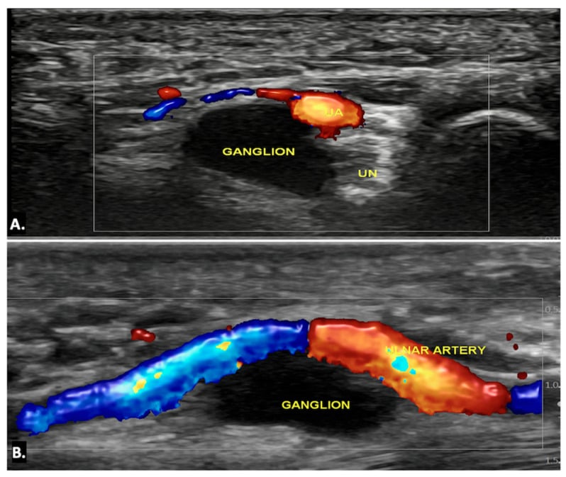Ultrasound of Guyon canal showing an anechoic ganglion labelled G displacing the ulnar artery UA and sitting next to the ulnar nerve UN.