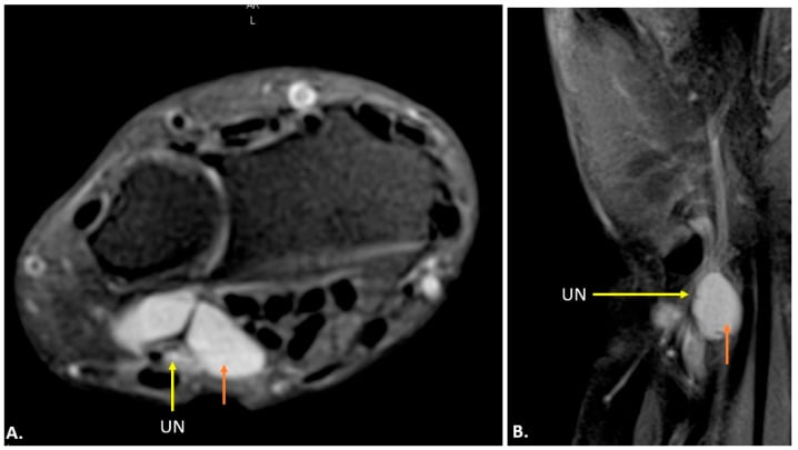 Axial T2 MRI of the wrist with a hyperintense ganglion in Guyon canal compressing the ulnar nerve.