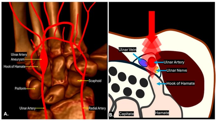 Line drawing of Guyon canal in cross-section comparing a ganglion, an ulnar-artery aneurysm and thrombosis with labelled ulnar nerve and artery.