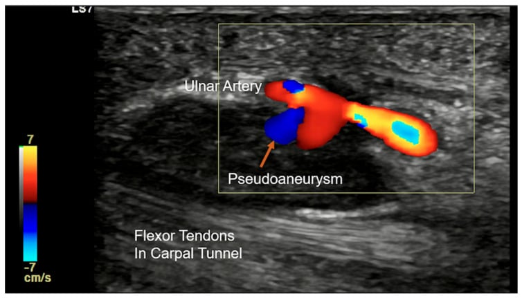 Colour Doppler ultrasound of the ulnar artery showing a yin-yang flow pattern in a pseudoaneurysm sac.