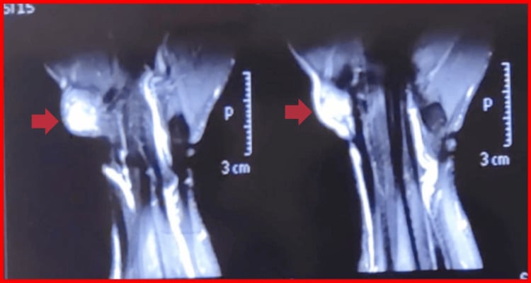 Axial T2 MRI of the wrist showing a hyperintense mass around the flexor carpi radialis tendon.