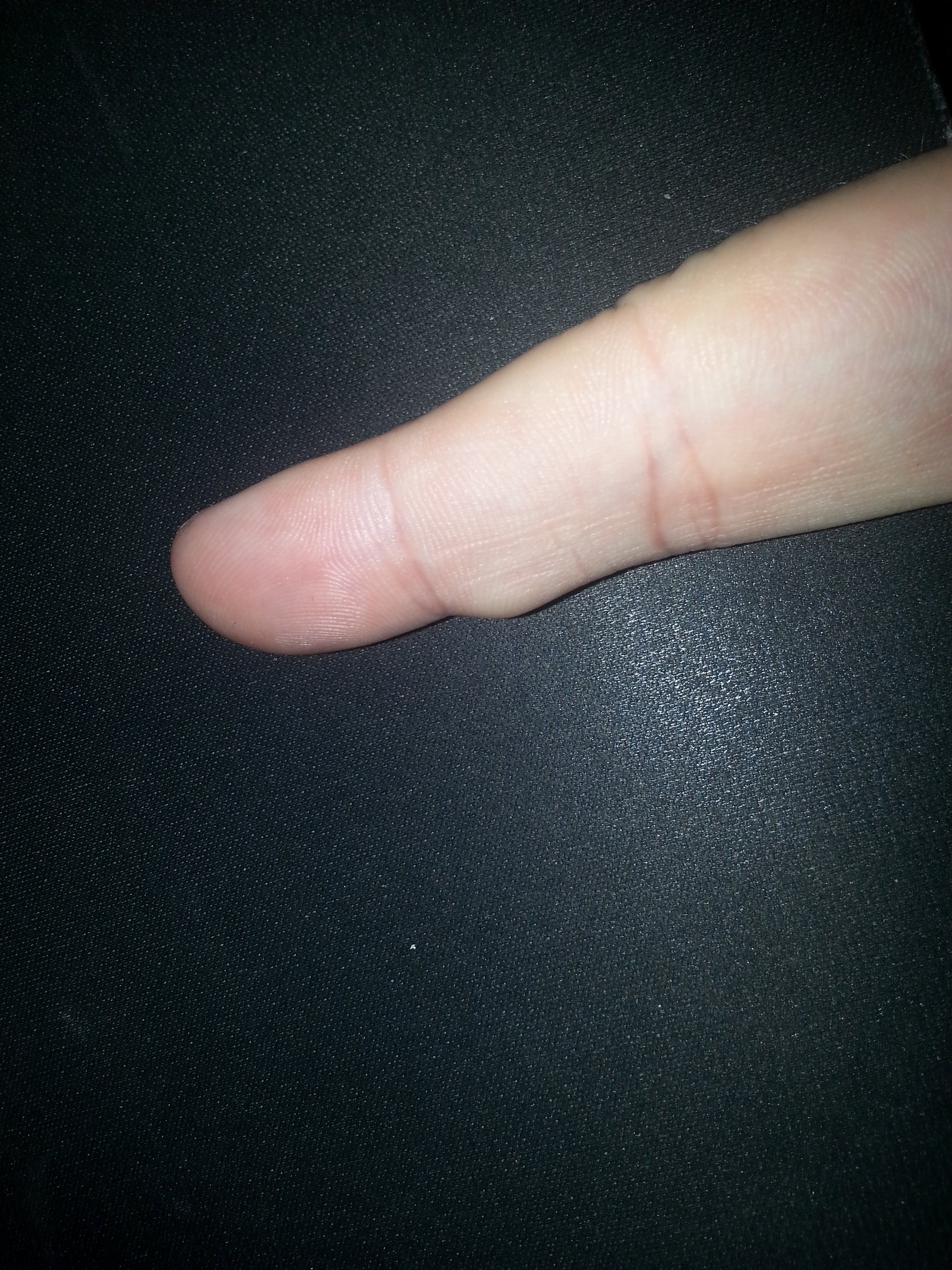 Right index finger with a smooth subcutaneous cyst over the radial aspect of the proximal interphalangeal joint; no face visible.