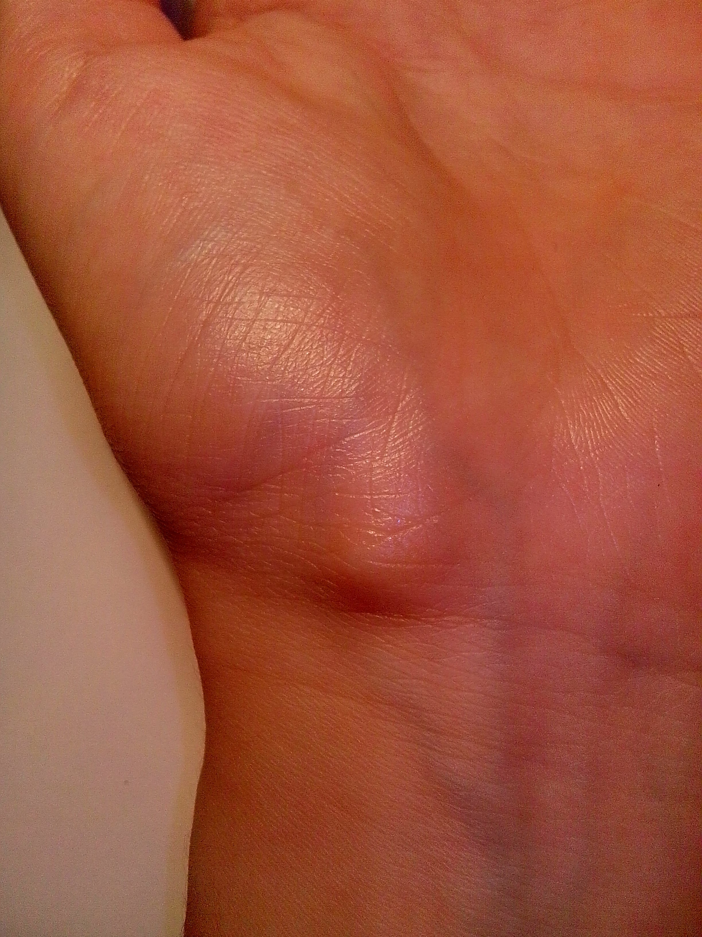 Volar left wrist with a smooth subcutaneous swelling just distal to the palmar wrist crease.