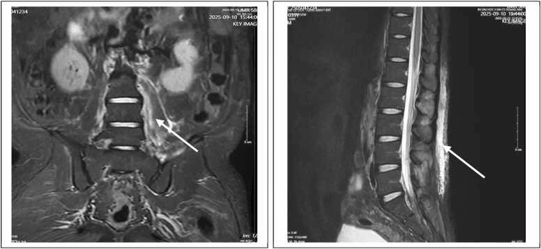 Coronal and sagittal MRI in disseminated pyomyositis, arrows marking abnormal signal in the muscle beside the lumbar spine and in the posterior paraspinal muscles