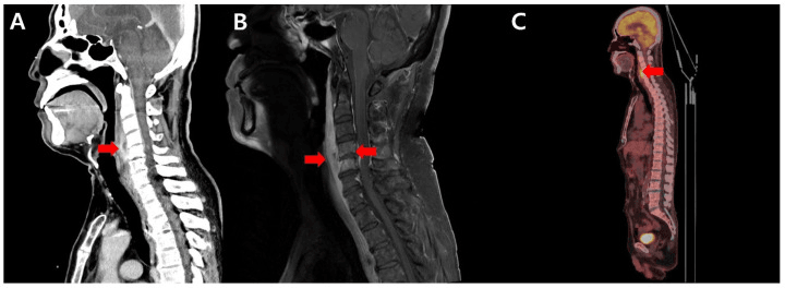Cervical CT MRI and PET showing tuberculous spondylitis and prevertebral cold abscess
