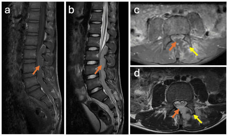 Lumbar MRI showing septic facet arthritis with posterior epidural abscess and compression