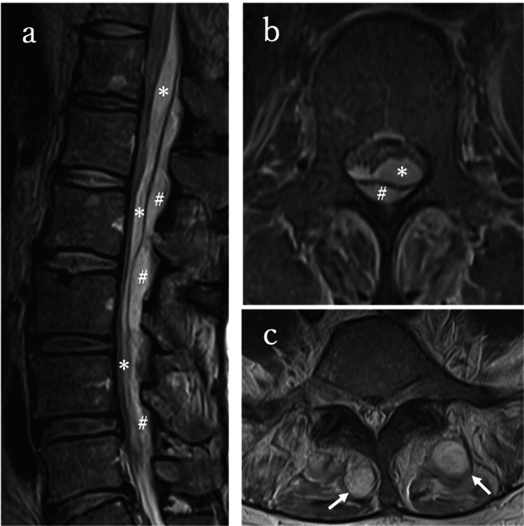 Spine MRI showing multifidus abscess with subdural and epidural empyema