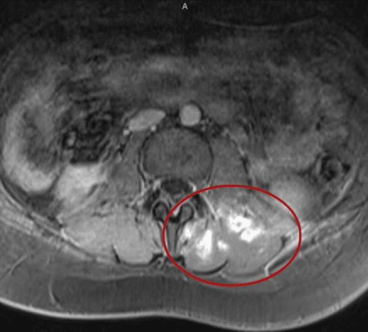 Axial lumbar MRI showing multiple paraspinal pyomyositis abscesses