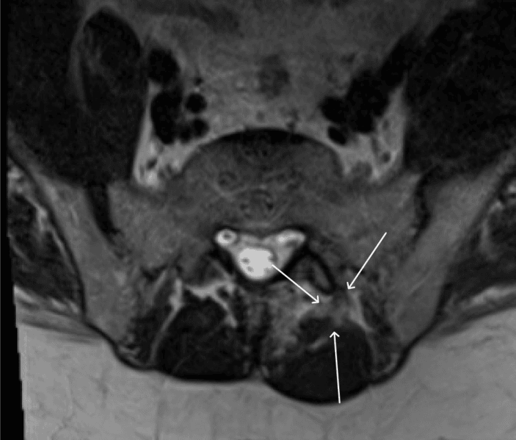 Axial lumbar MRI showing paraspinal muscle oedema without abscess