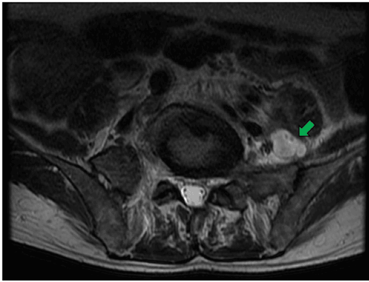 Axial lumbar MRI showing a left psoas abscess