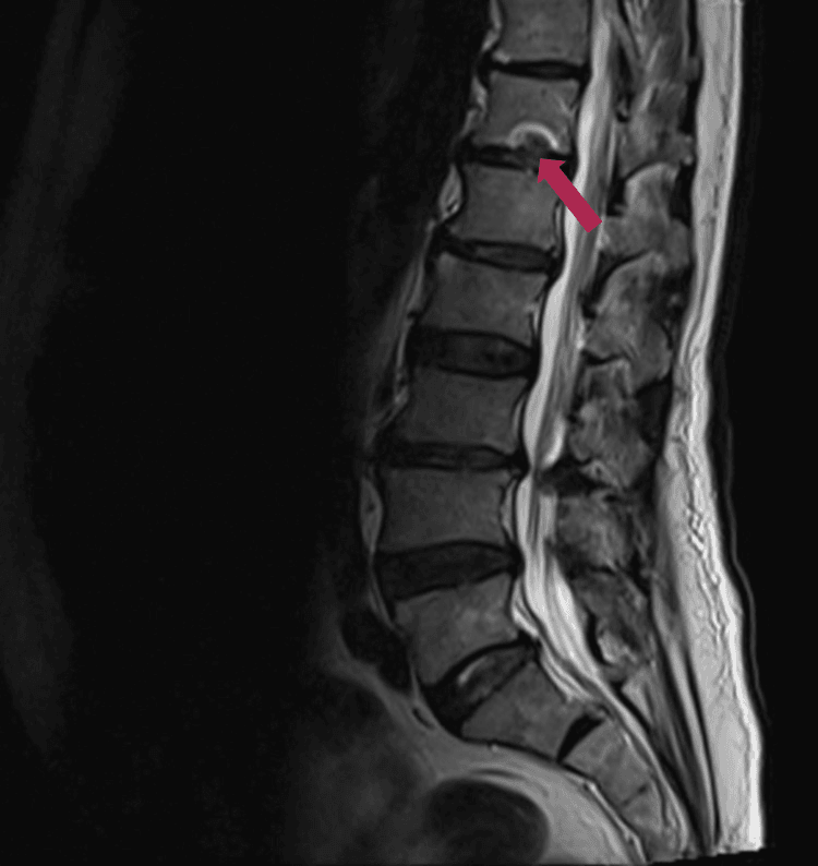Sagittal lumbar MRI from a case of septic facet arthritis with an adjacent paraspinal collection, an arrow marking a small focus of abnormal signal at the back of an upper lumbar level