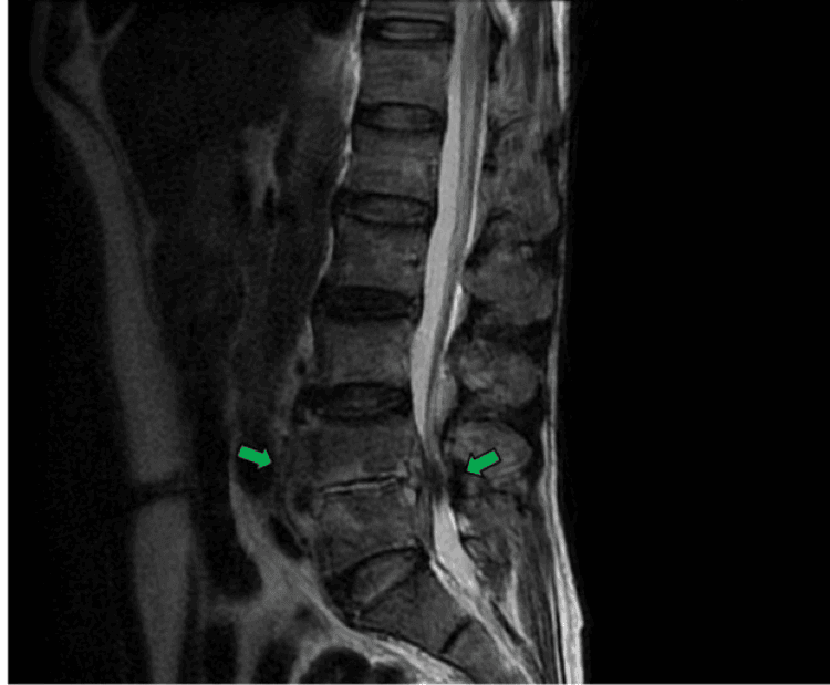 Sagittal lumbar MRI showing spondylodiscitis and paravertebral inflammation
