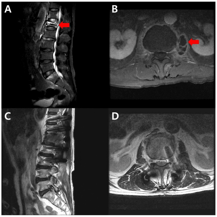 Four-panel thoracolumbar MRI of tuberculous spondylitis with a paraspinal abscess: sagittal and axial images with arrows (A, B) and sagittal and axial follow-up images (C, D)