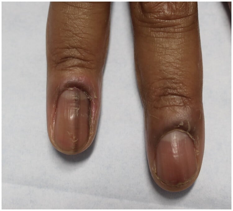 Two fingernails with chronic paronychia: oedematous proximal nail folds, lost cuticles and no pointing abscess