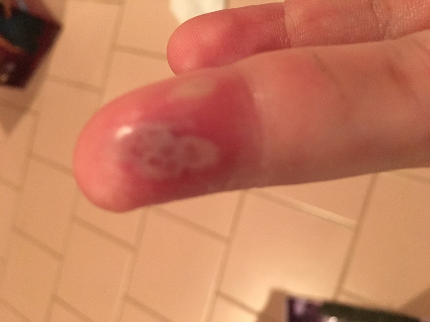 Clinical presentation of herpetic whitlow: grouped clear vesicles on an erythematous, swollen fingertip pulp