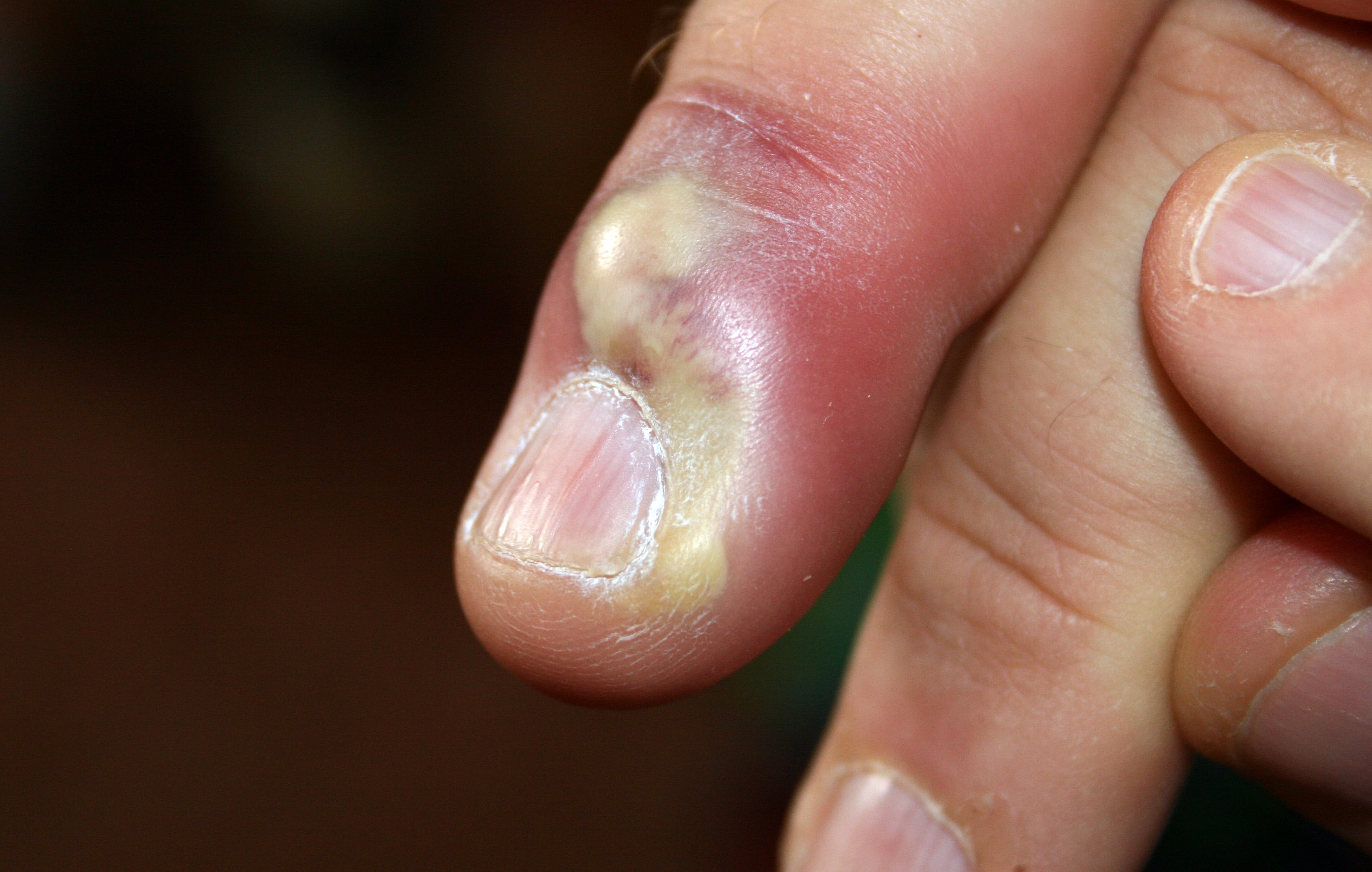 Close-up photograph showing the nail-fold (perionychium) anatomy of a thumb with acute paronychia - a pus-filled abscess at the nail fold structure with surrounding redness and swelling